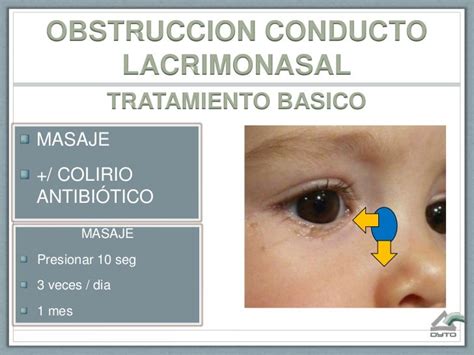 masaje lagrimal obstruido adultos|tratamiento de conducto lagrimal obstruido.